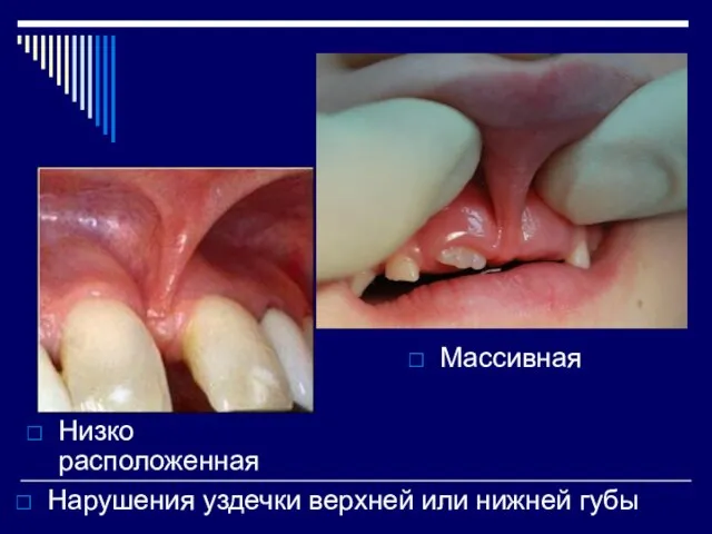 Нарушения уздечки верхней или нижней губы Низко расположенная Массивная