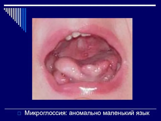 Микроглоссия: аномально маленький язык