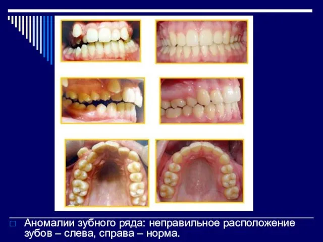 Аномалии зубного ряда: неправильное расположение зубов – слева, справа – норма.