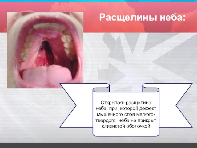 Расщелины неба: Открытая- расщелина неба, при которой дефект мышечного слоя мягкого-