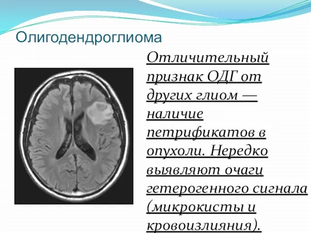 Олигодендроглиома Отличительный признак ОДГ от других глиом — наличие петрификатов в