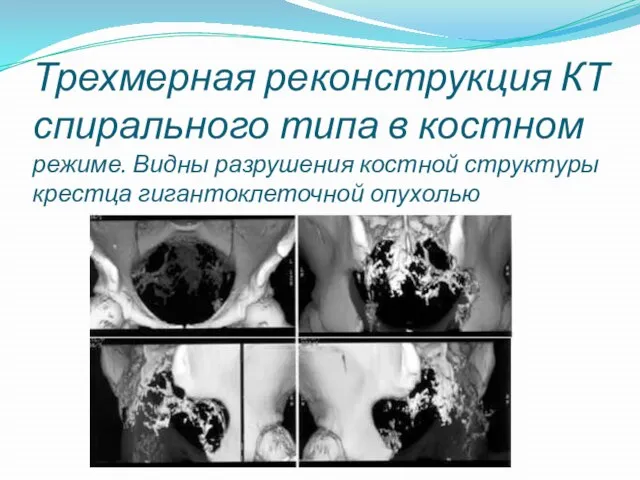 Трехмерная реконструкция КТ спирального типа в костном режиме. Видны разрушения костной структуры крестца гигантоклеточной опухолью