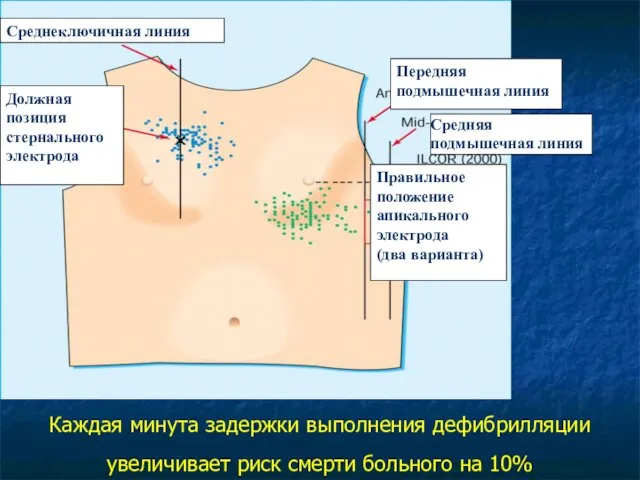 Каждая минута задержки выполнения дефибрилляции увеличивает риск смерти больного на 10%