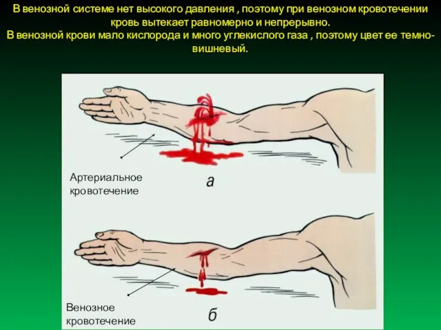 В венозной системе нет высокого давления , поэтому при венозном кровотечении