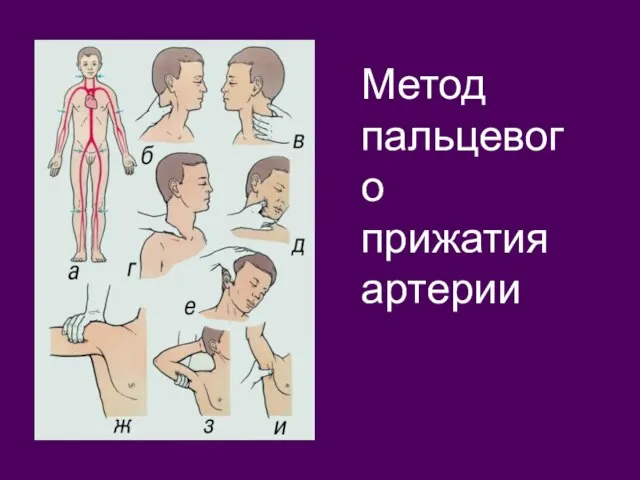 Метод пальцевого прижатия артерии