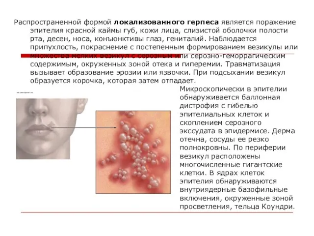 Распространенной формой локализованного герпеса является поражение эпителия красной каймы губ, кожи