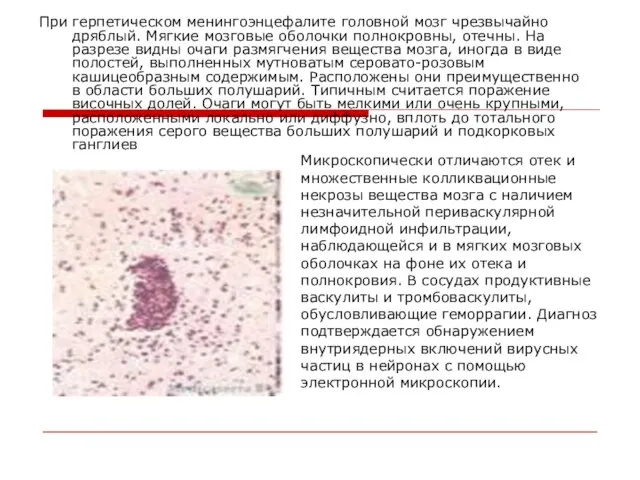 При герпетическом менингоэнцефалите головной мозг чрезвычайно дряблый. Мягкие мозговые оболочки полнокровны,