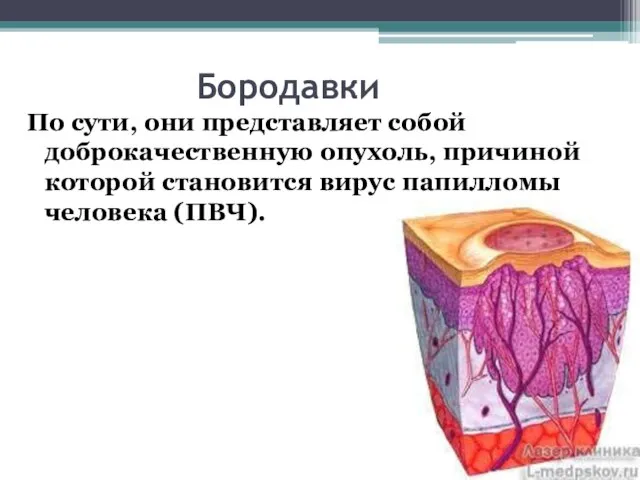 Бородавки По сути, они представляет собой доброкачественную опухоль, причиной которой становится вирус папилломы человека (ПВЧ).