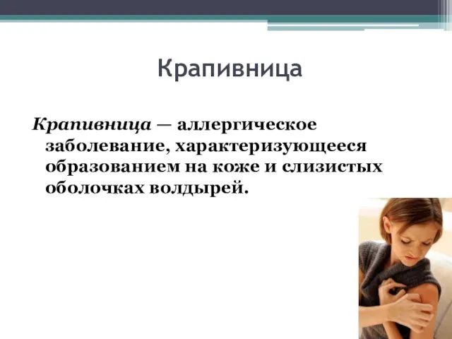 Крапивница Крапивница — аллергическое заболевание, характеризующееся образованием на коже и слизистых оболочках волдырей.