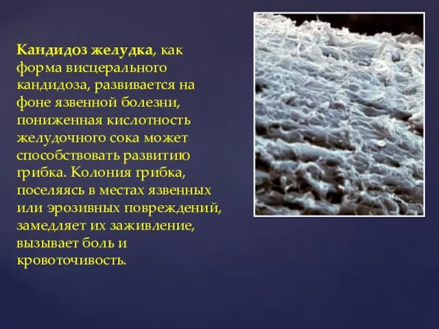 Кандидоз желудка, как форма висцерального кандидоза, развивается на фоне язвенной болезни,