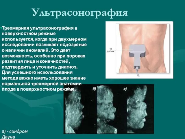 Ультрасонография a) - синдром Дауна Трехмерная ультрасонография в поверхностном режиме используется,