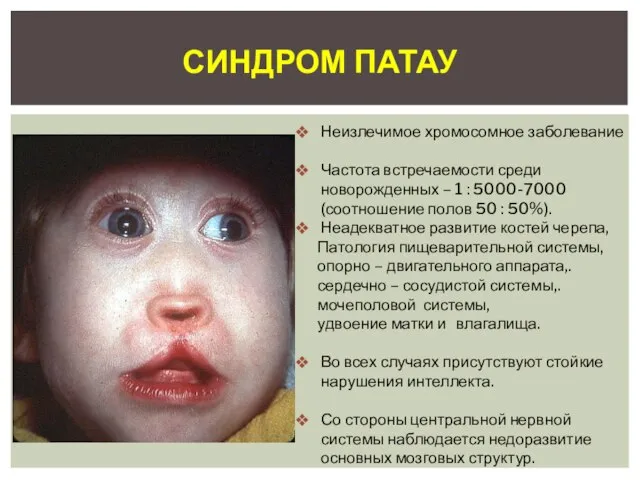 Синдром Патау Неизлечимое хромосомное заболевание Частота встречаемости среди новорожденных – 1