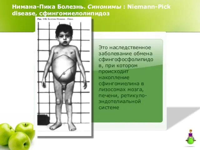 Нимана-Пика Болезнь. Синонимы : Niemann-Pick disease, сфингомиелолипидоз Это наследственное заболевание обмена