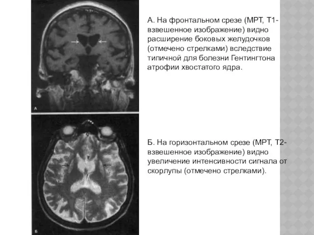 А. На фронтальном срезе (МРТ, Т1-взвешенное изображение) видно расширение боковых желудочков