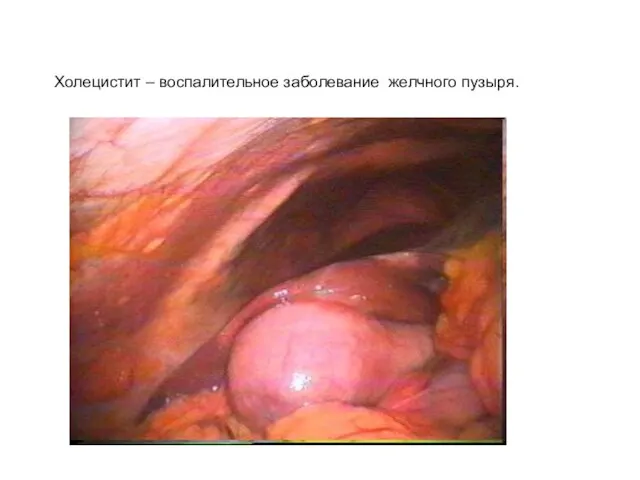 Холецистит – воспалительное заболевание желчного пузыря.