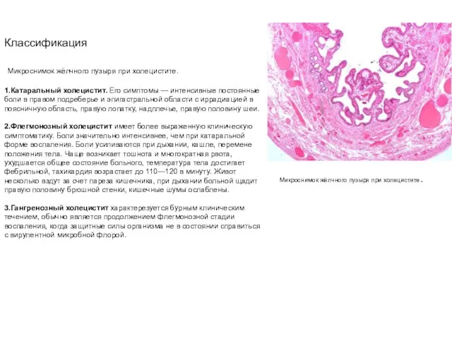 Классификация Микроснимок жёлчного пузыря при холецистите. 1.Катаральный холецистит. Его симптомы —
