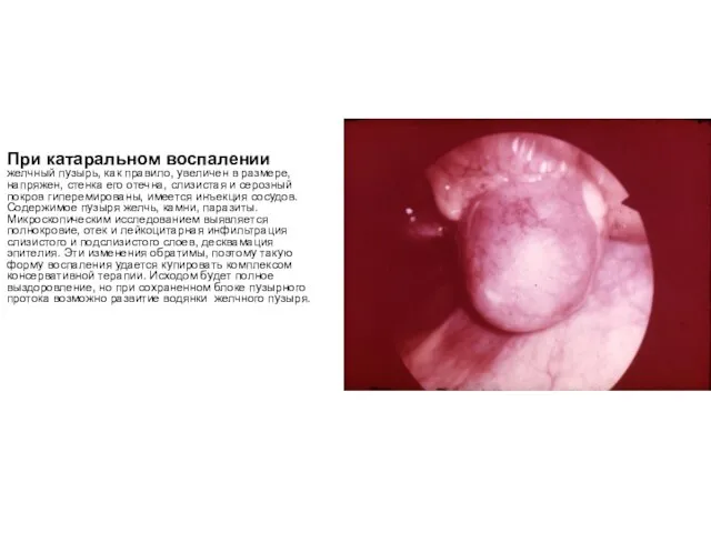 При катаральном воспалении желчный пузырь, как правило, увеличен в размере, напряжен,