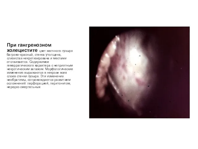 При гангренозном холецистите цвет желчного пузыря багрово-красный, стенка утолщена, слизистая некротизирована