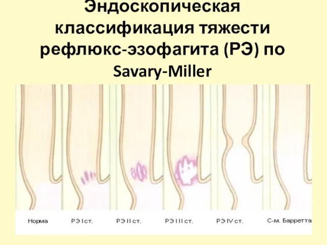 Эндоскопическая классификация тяжести рефлюкс-эзофагита (РЭ) по Savary-Miller