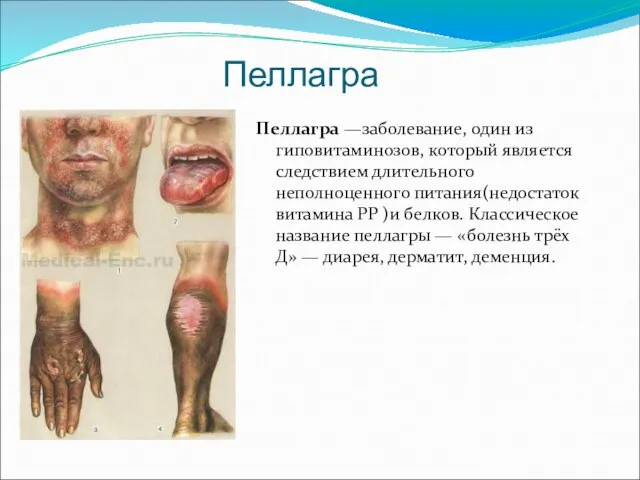 Пеллагра Пеллагра —заболевание, один из гиповитаминозов, который является следствием длительного неполноценного