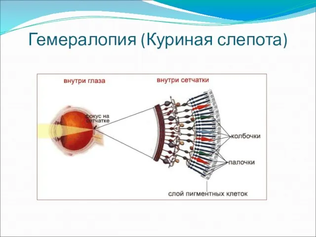 Гемералопия (Куриная слепота)