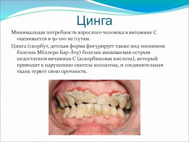 Цинга Минимальная потребность взрослого человека в витамине С оценивается в 50-100