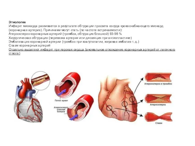 Этиология Инфаркт миокарда развивается в результате обтурации просвета сосуда кровоснабжающего миокард