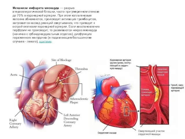 Механизм инфаркта миокарда — разрыв атеросклеротической бляшки, часто при умеренном стенозе
