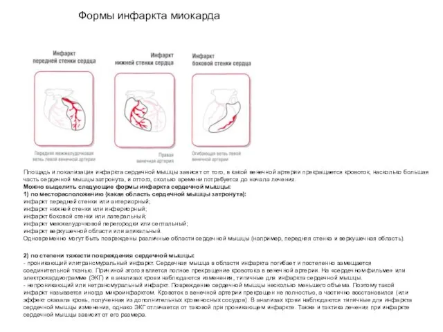 Формы инфаркта миокарда Площадь и локализация инфаркта сердечной мышцы зависят от