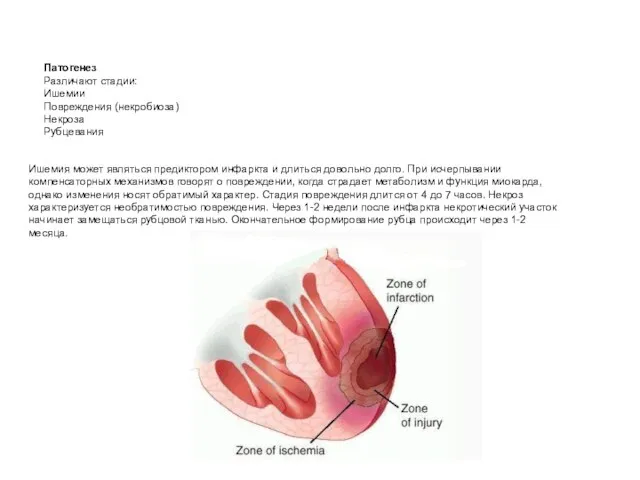 Патогенез Различают стадии: Ишемии Повреждения (некробиоза) Некроза Рубцевания Ишемия может являться