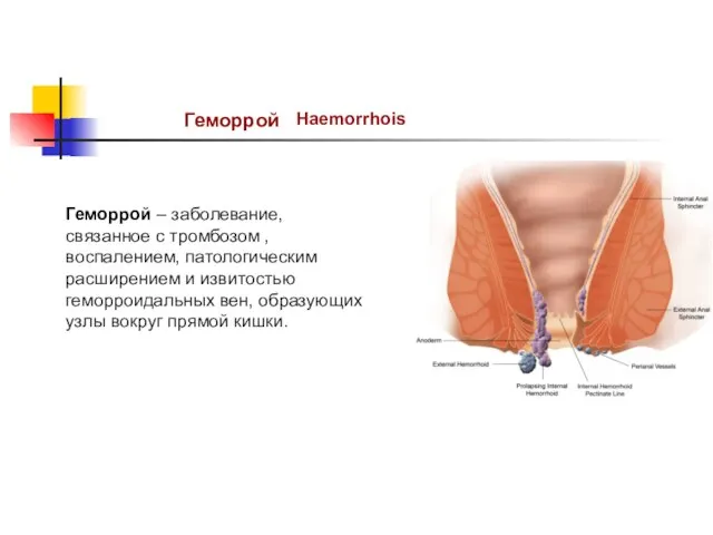 Геморрой Haemorrhois Геморрой – заболевание, связанное с тромбозом , воспалением, патологическим