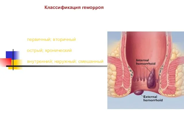 Классификация геморроя первичный; вторичный острый; хронический внутренний; наружный; смешанный