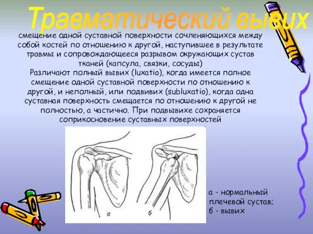 Травматический вывих смещение одной суставной поверхности сочленяющихся между собой костей по