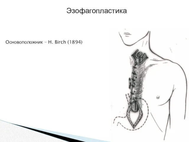 Эзофагопластика Основоположник – H. Birch (1894)