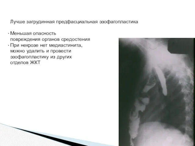 Лучше загрудинная предфасциальная эзофагопластика Меньшая опасность повреждения органов средостения При некрозе