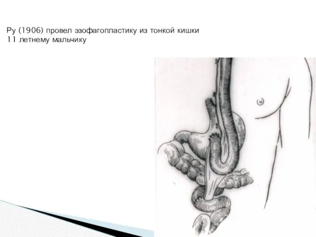 Ру (1906) провел эзофагопластику из тонкой кишки 11 летнему мальчику