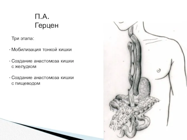 П.А. Герцен Три этапа: Мобилизация тонкой кишки Создание анастомоза кишки с