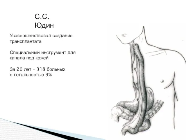 С.С. Юдин Усовершенствовал создание трансплантата Специальный инструмент для канала под кожей