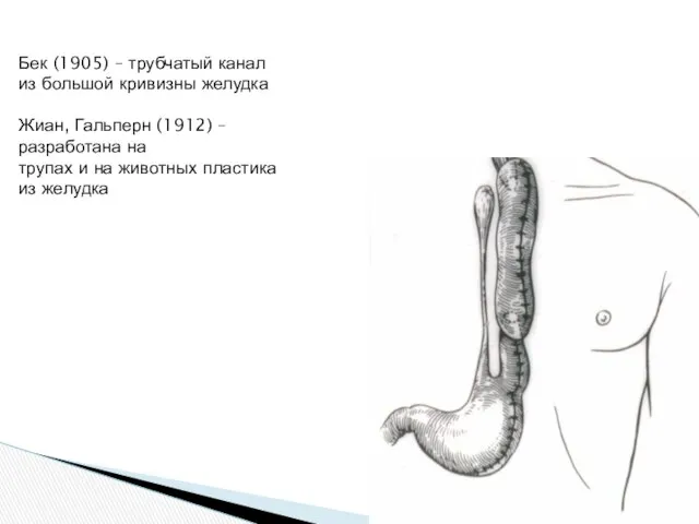 Бек (1905) – трубчатый канал из большой кривизны желудка Жиан, Гальперн