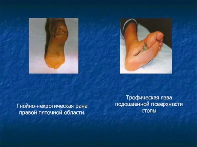 Трофическая язва подошвенной поверхности стопы Гнойно-некротическая рана правой пяточной области.