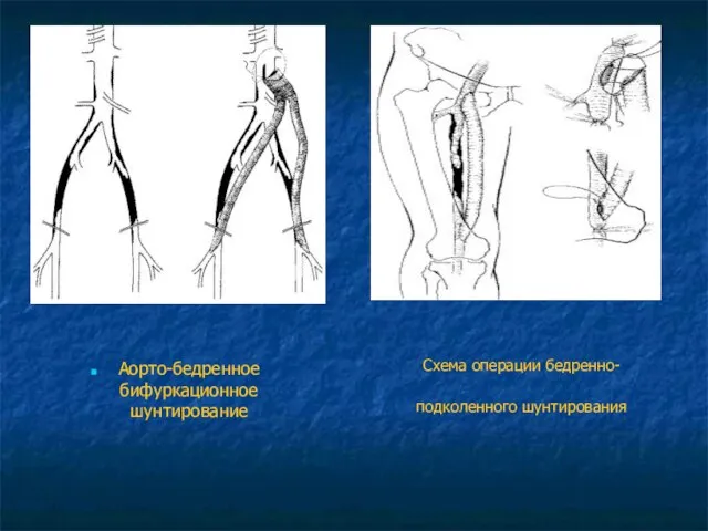 Схема операции бедренно-подколенного шунтирования Аорто-бедренное бифуркационное шунтирование