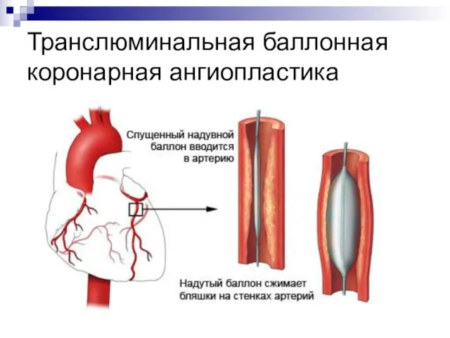 Транслюминальная баллонная коронарная ангиопластика