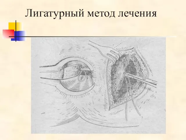 Лигатурный метод лечения