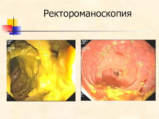 Ректороманоскопия