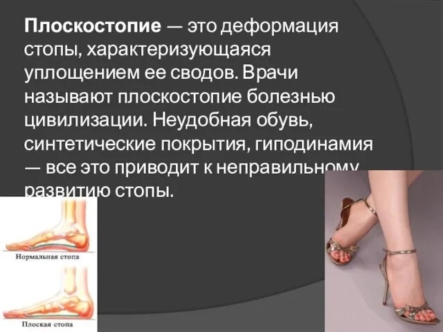 Плоскостопие — это деформация стопы, характеризующаяся уплощением ее сводов. Врачи называют