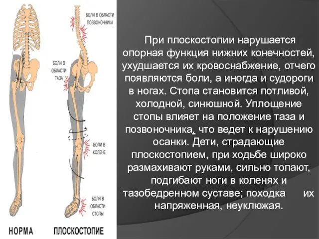 При плоскостопии нарушается опорная функция нижних конечностей, ухудшается их кровоснабжение, отчего