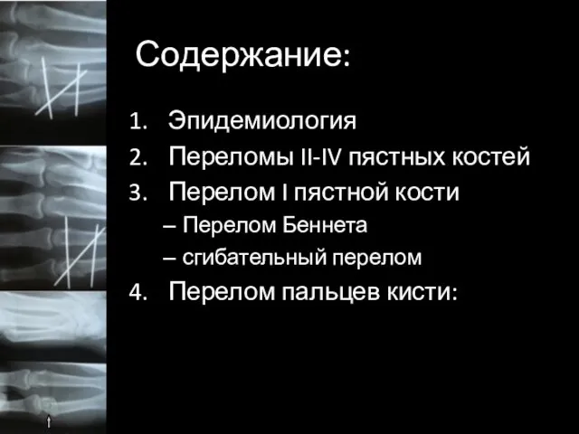 Содержание: Эпидемиология Переломы II-IV пястных костей Перелом I пястной кости Перелом