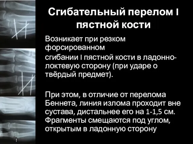 Сгибательный перелом I пястной кости Возникает при резком форсированном сгибании I