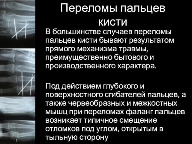 Переломы пальцев кисти В большинстве случаев переломы пальцев кисти бывают результатом