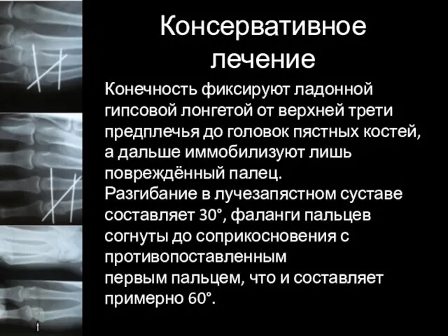 Консервативное лечение Конечность фиксируют ладонной гипсовой лонгетой от верхней трети предплечья